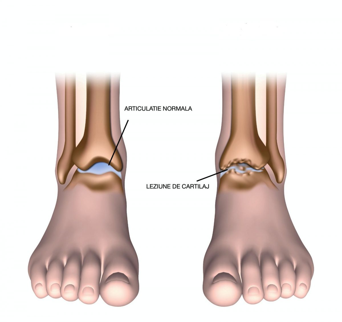 Cum să eliminați edemul după un picior rupt - Calusuri 