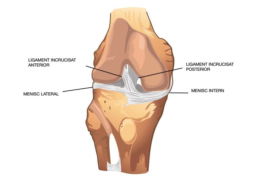 Deteriorarea meniscului medial al articulației genunchiului drept