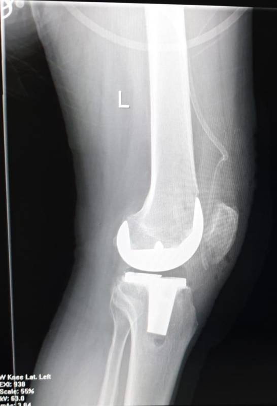 ateroscleroza tratamentului articulației genunchiului)