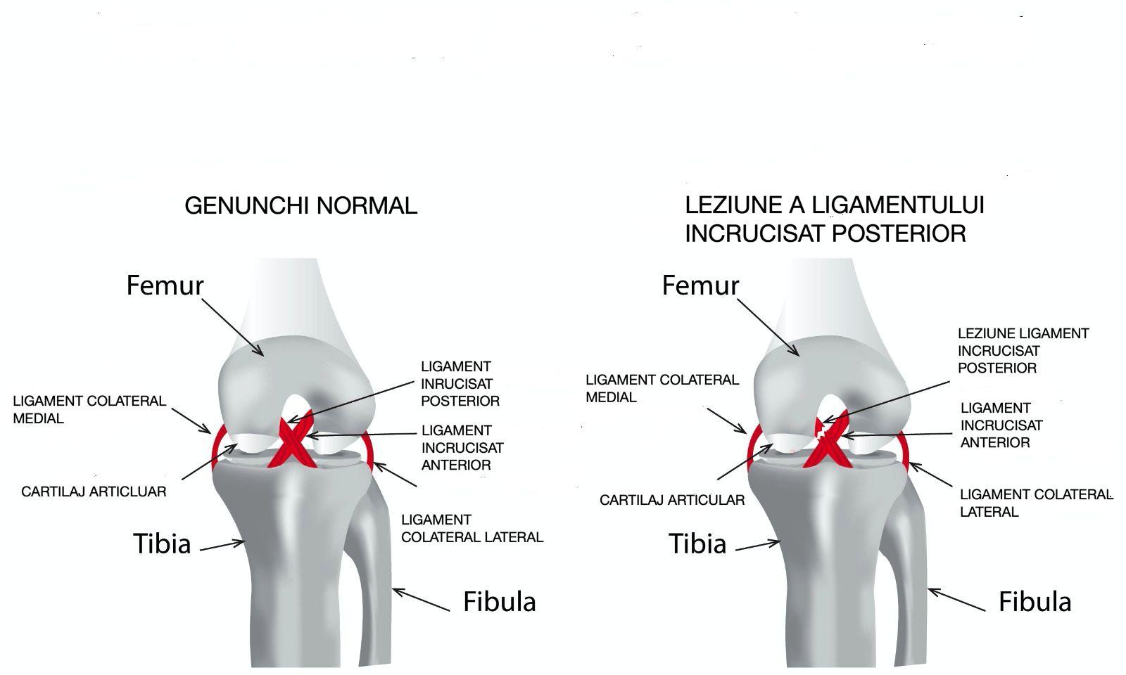 dureri la nivelul umerilor cum să tratezi articulația displazică a genunchiului