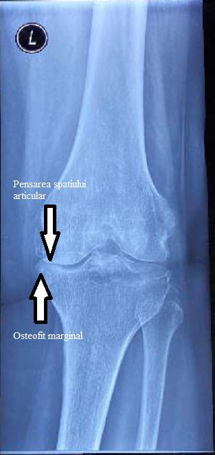 tratament osteofite genunchi