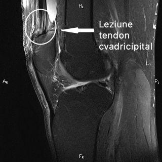 leziune-tendon-cvadricipital