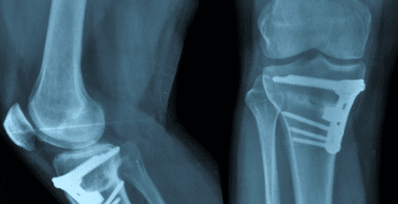 Osteotomia genunchiului