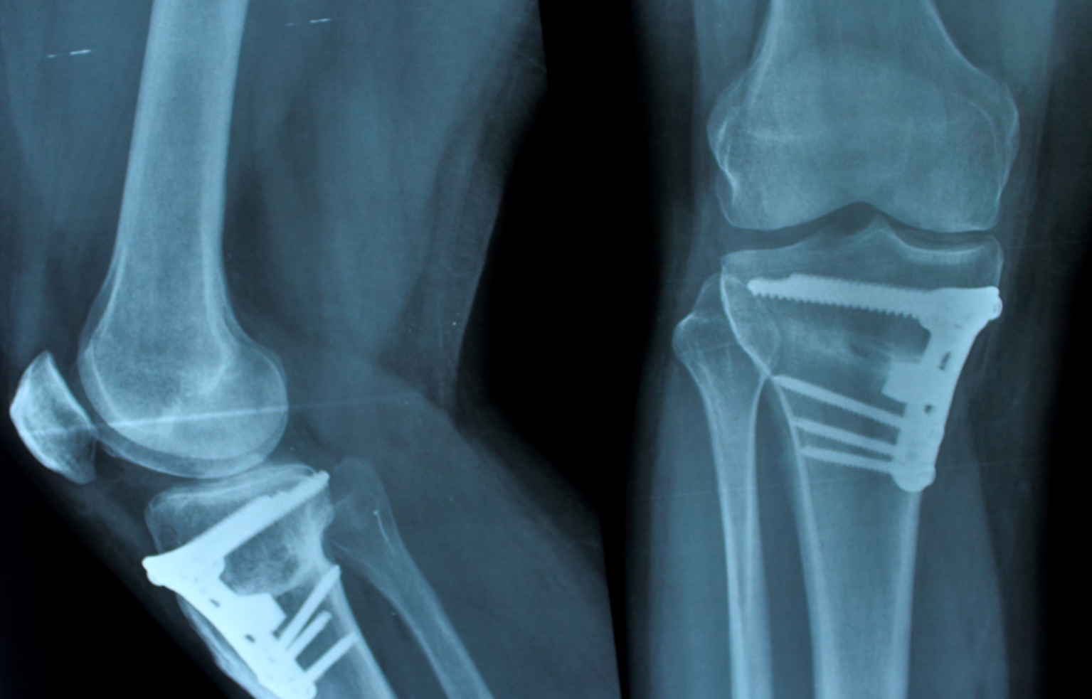 Osteotomia genunchiului